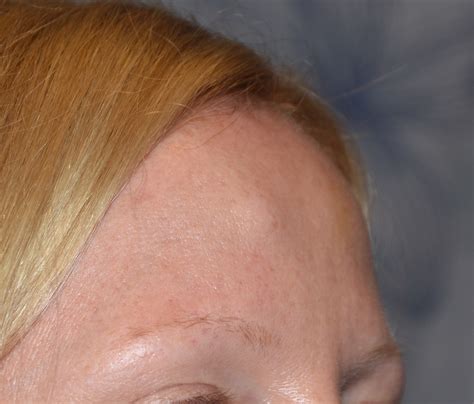 Forehead Lipoma Oblique View Dr Barry Eppley Indianapolis Explore
