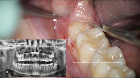 Estrazione Dente Del Giudizio Incluso Con Chirurgia Sonica Dr Fabio