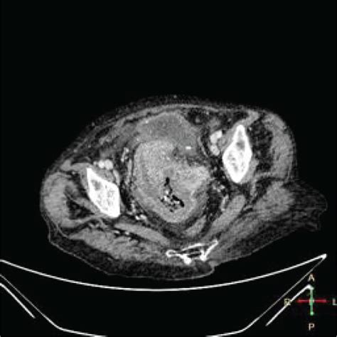 Axial Pelvic Computed Tomography Of The Patient Showing The Enlarged