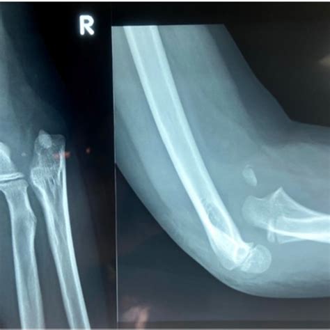 AP And Lateral Radiographs Of Right Elbow Joint Showing Anteromedial