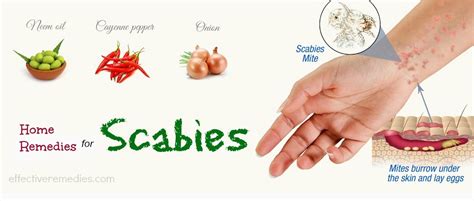 Top 20 Natural Home Remedies For Scabies Treatment In Humans