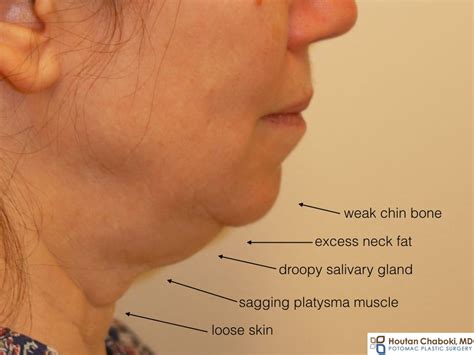 Double Chin Treatment Which Surgery Is Best Before And After Photos