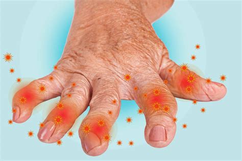 Healthline Pictures And Symptoms Of Arthritis In The Fingers