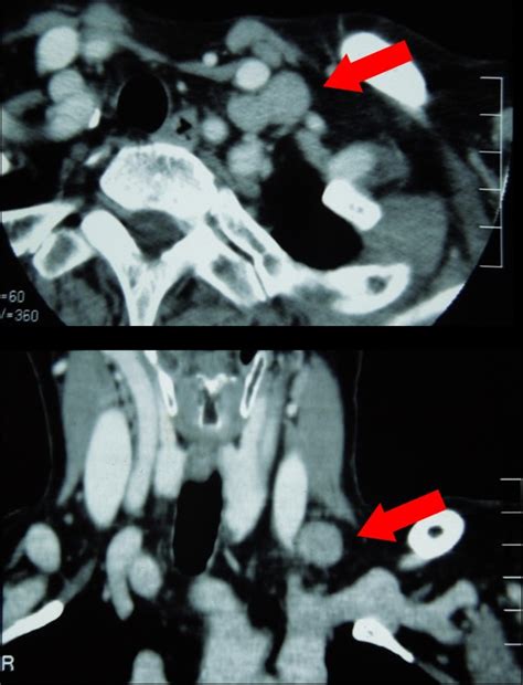 Preoperative Ct Findings The Ct Showed A Single Left Supraclavicular