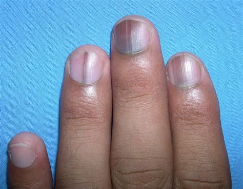 Melanonychia On Nails Symptoms Causes And Treatment
