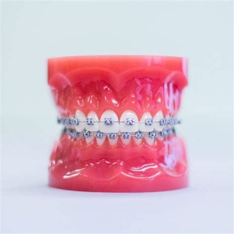 Custom 3d Printed Clear Braces Inman Park Orthodontics And Pediatric Dentistry