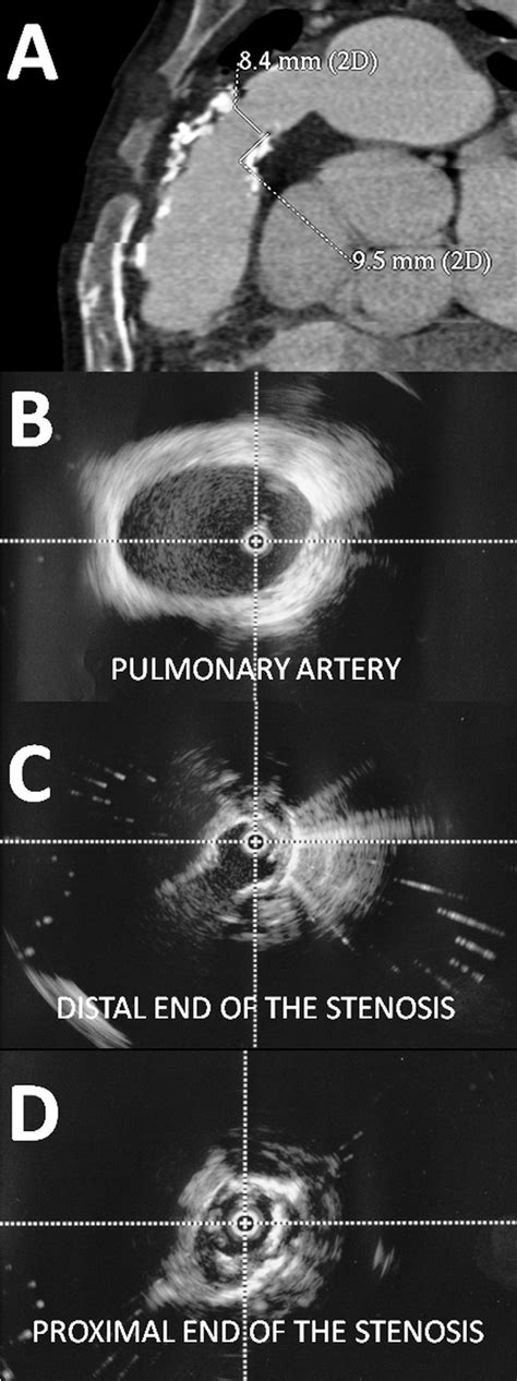 Figure 1 From Imaging For Trans Catheter Pulmonary Stent Valve