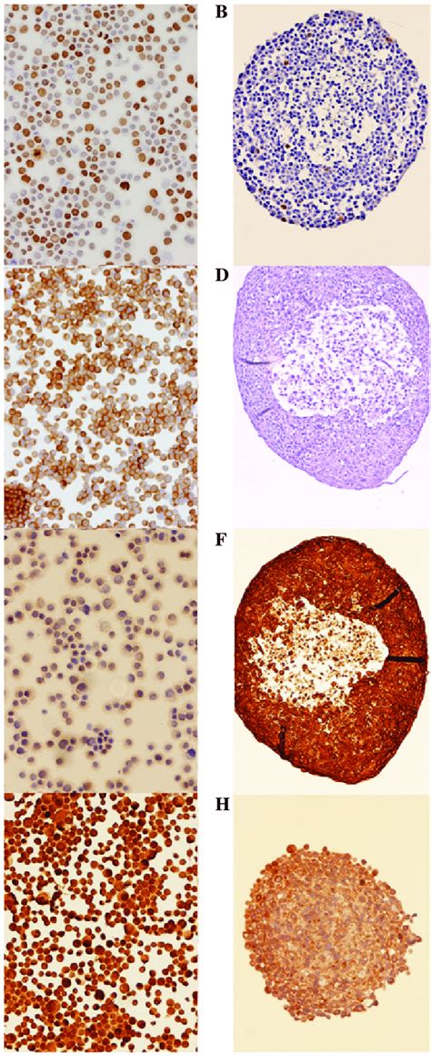 Immunohistochemical Staining Of Head And Neck Squamous Cell Carcinoma