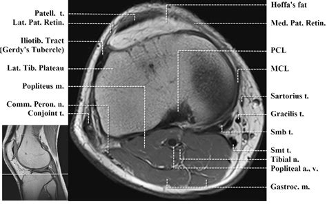 Figure 4 From Normal Mr Imaging Anatomy Of The Knee Semantic Scholar
