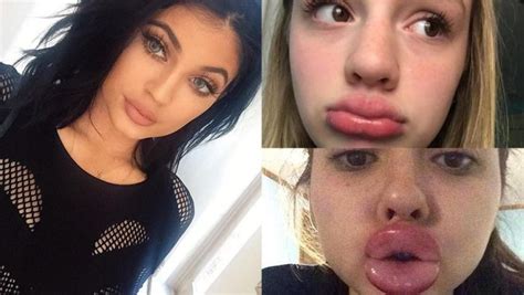 The Kylie Jenner Lip Challenge Has Turned Into A Complete Disaster 19