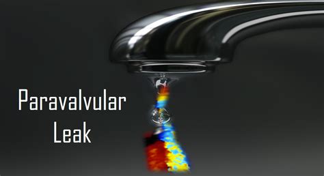 Paravalvular Leak A Guide For Patients • Myheart