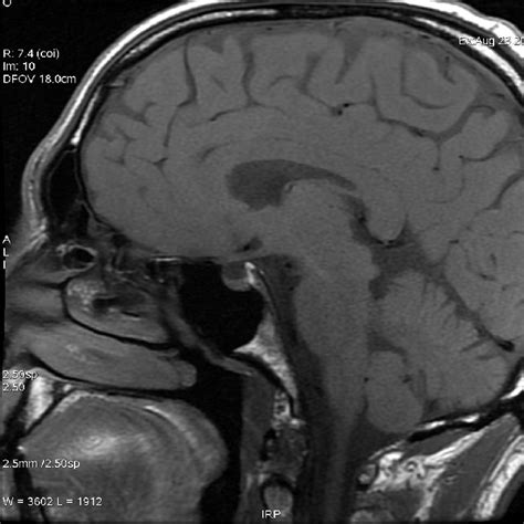 Sagittal T1 Weighted Mri Showing A Partial Empty Sella Syndrome