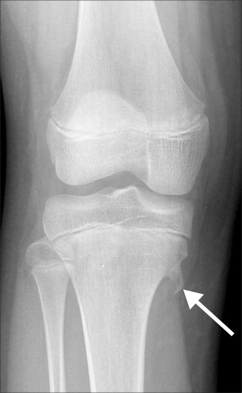 Osteochondroma Is A Benign Tumor Characterized By An Overgrowth Of