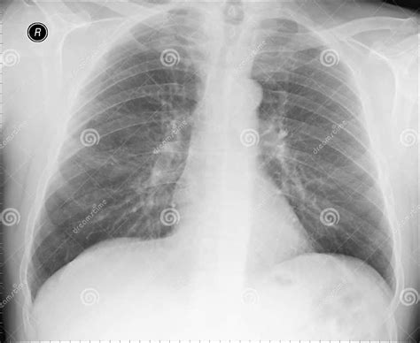 Normal Chest X Ray Stock Image Image Of Cords Film 15679493