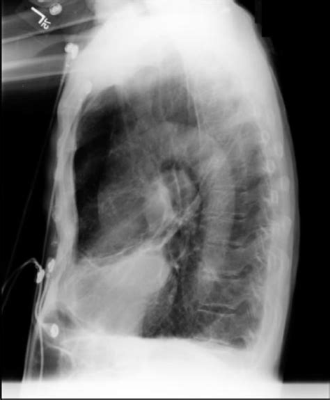 Chest Radiograph Displaying Extensive Calcification Of Open I