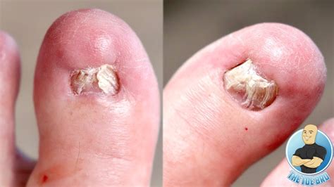 Damaged And Deformed Big Toenails After Failed Nail Surgeries Removing Them Forever Youtube