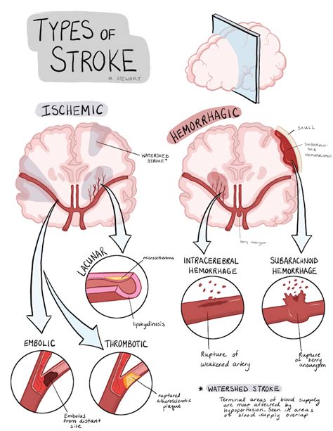 Need A Review Of The Different Types Of Stroke Stroke Can Be Divided
