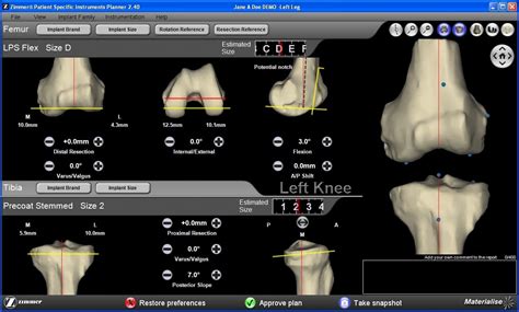Custom Knee Replacement Knee Arthritis Relief Dr Nakul Karkare