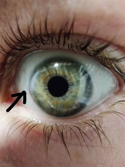 What Is This White Patch On My Iris Noticed It A Few Days Ago No Pain