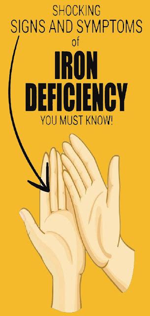 13 Signs And Symptoms That You Have An Iron Deficiency Healthy Zilla