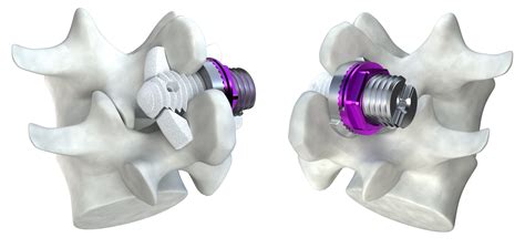 Minuteman Minimally Invasive Spinal Fusion Advanced Pain Management