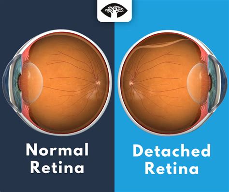 Retinal Detachment Dont Ignore The Warning Signs Dr Cronje