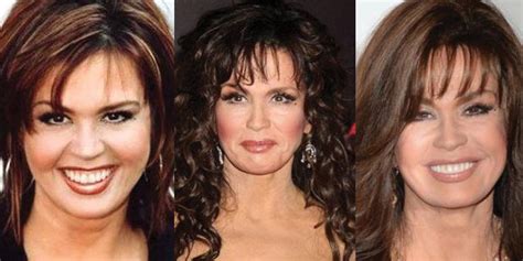 Marie Osmond Before After Plastic Surgery