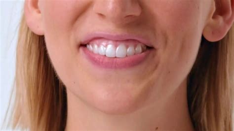 Smile Direct Club Aligner Tv Spot Works Simply Ispottv