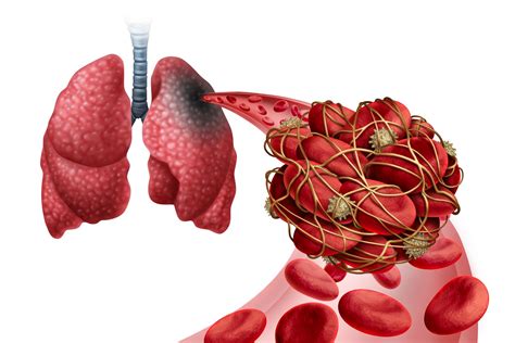 Risk Of Serious Blood Clot Events Spike In The Months After Covid 19