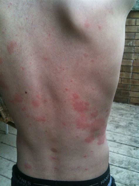 Pictures Of Skin Rashes