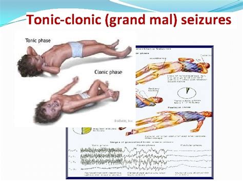 Antiepileptic Drugs Definition Epilepsy Is A Chronic Medical