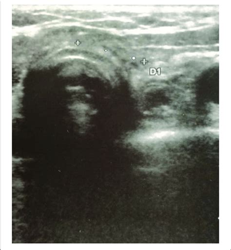 Neck Ultrasonography Performed At 10 Month Follow Up Visit After The