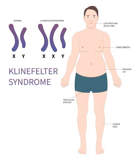 Klinefelter Syndrome And Male Fertility
