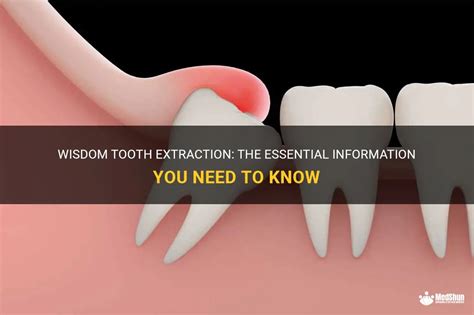 Wisdom Tooth Extraction The Essential Information You Need To Know