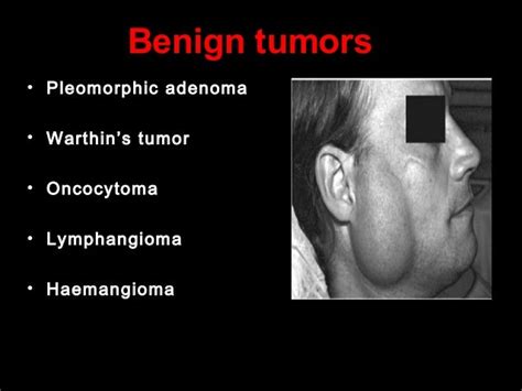 Benign And Malignat Tumors Of Salivary Gland