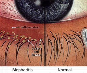 Hypnotic Lashes Blog: Blepharitis the enemy of eyelash extensions!!