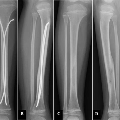 Radiographs Of The Left Tibia 6 Months After Elastic Intramedullary