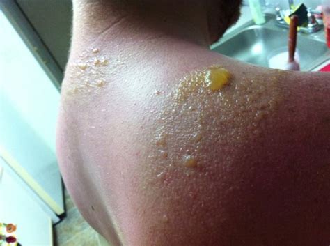 Pin By Maxine Cooper On Injuries 2nd Degree Burns Severe Sunburn Degree Burns