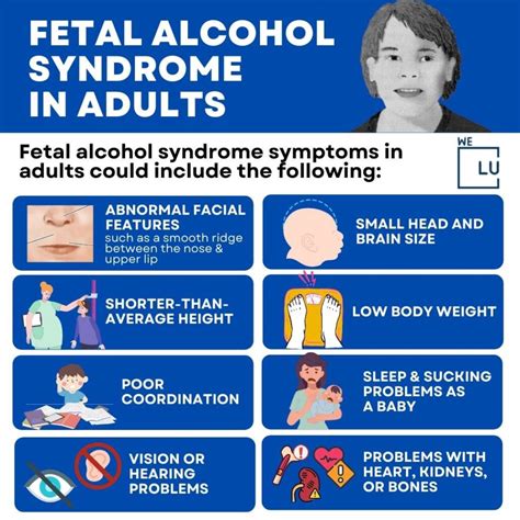 Fetal Alcohol Syndrome In Adults Symptoms Facial Signs