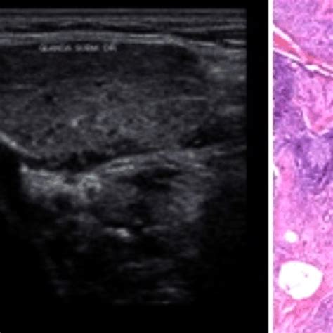 Chronic Submandibular Sialadenitis Clinical Aspect Submandibular