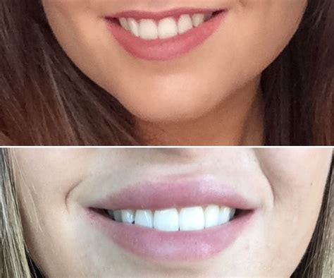lipfillers lip fillers lip injections perfect lips