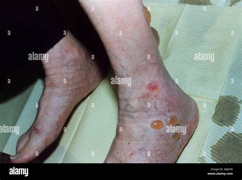 Blisters Caused By Diabetes Mellitus On The Leg Stock Photo Royalty