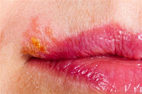 Herpes On The Lip Close Up Macro Stock Image Image Of Disgusting