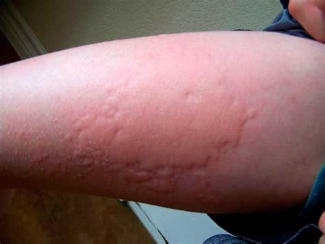 Allergy To Mosquito Bites In Children Photo And Treatment