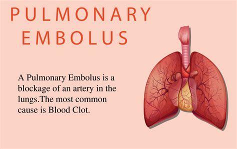 What Is Pulmonary Embolism Dr J C Suri