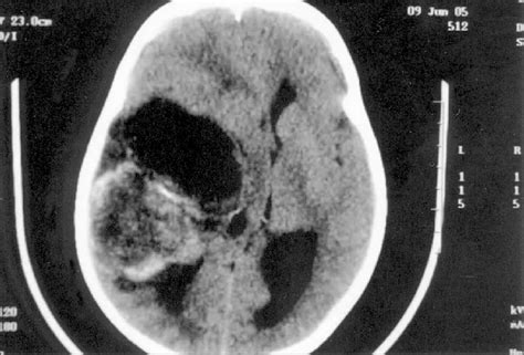 Computed Tomography Displaying A Bulk Tumor In Right Temporal Lobe
