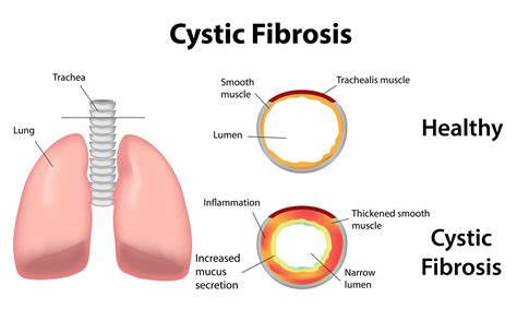 Unlocking The Benefits Increasing Protein Intake In Cystic Fibrosis