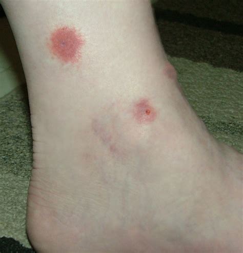 Different Types Of Spider Bites Pictures To Pin On Pinterest Pinsdaddy