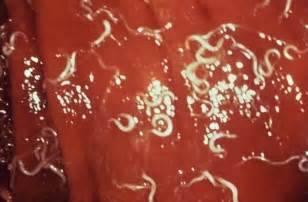 Get more tips on prevention and colitis is an inflammation of the colon, also known as the large intestine. The Potential Health Benefits of Parasitic Gut Worms | WIRED