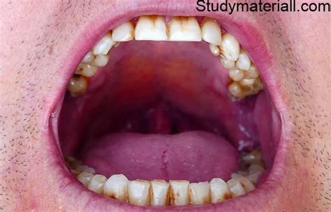 Oral Cancertypes Of Oral Cancerlip Cancer Symptoms And Management